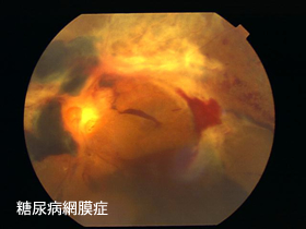増殖糖尿病網膜症 (Eye Surgery Now illustrated) 哲夫， 樋田 増殖糖尿病網膜症 (Eye Surgery Now illustrated) 哲夫， 樋田