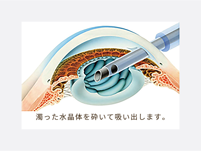 手術の流れ 犬山市 扶桑町の眼科なら宮田眼科へ